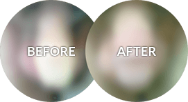 circumcision revision before and after photo