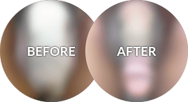 scrotoplasty revision before and after photo