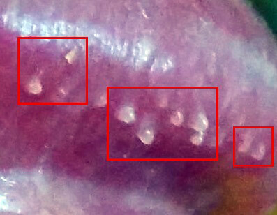 Hirsutoid papillomas treatment Hirsutoid papillomas, Erupții cutanate varicoase papula pe penis