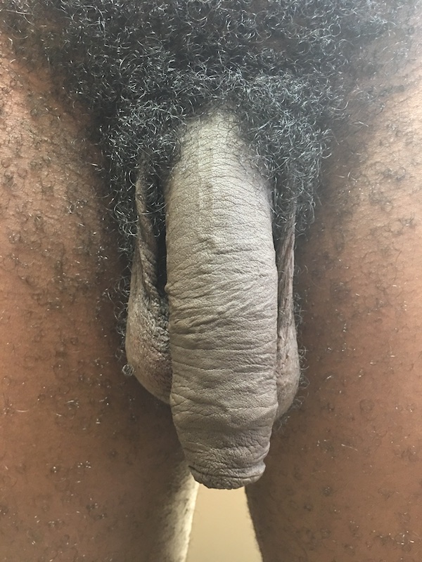 New Circumcisions Before & After Patient #458