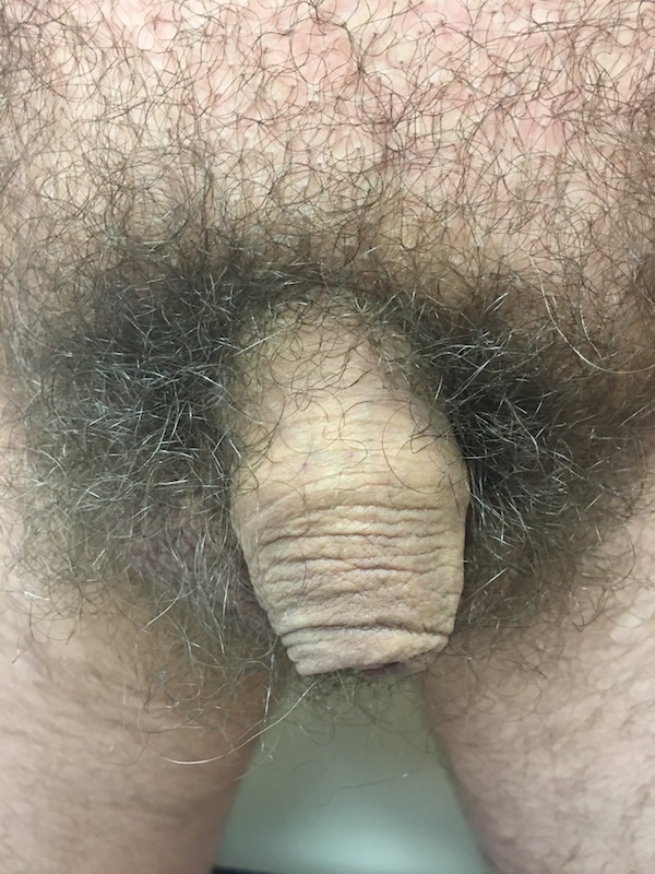 New Circumcisions Before & After Patient #488