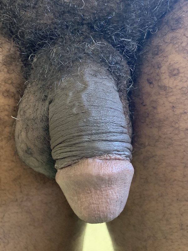 New Circumcisions Before & After Patient #516