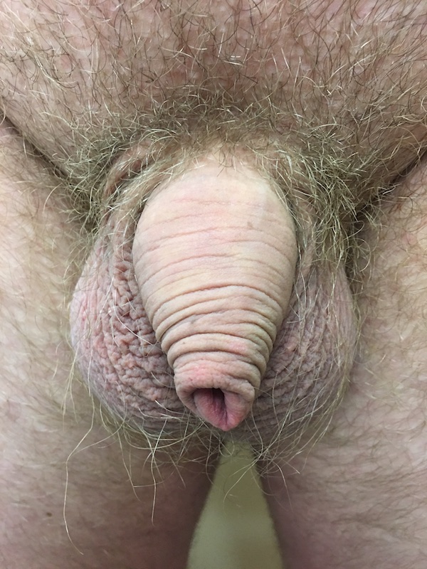 New Circumcisions Before & After Patient #532