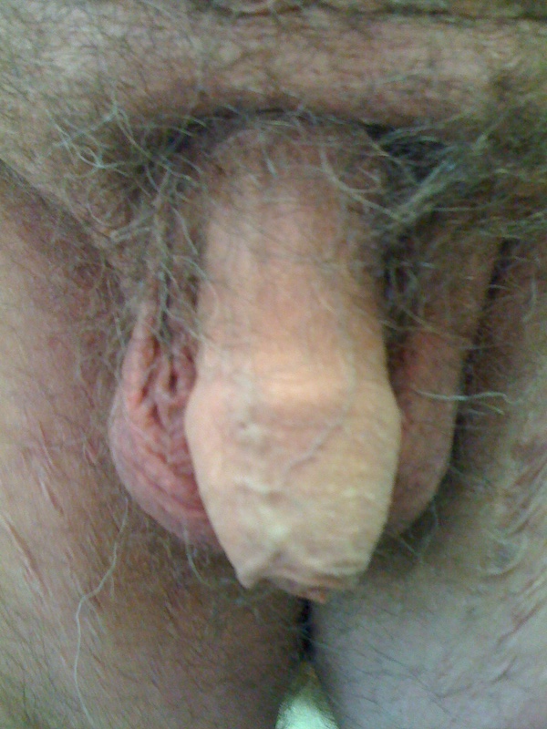 New Circumcisions Before & After Patient #592