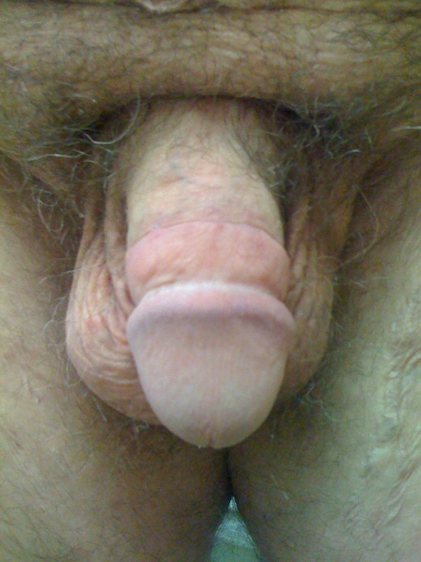 New Circumcisions Before & After Patient #592