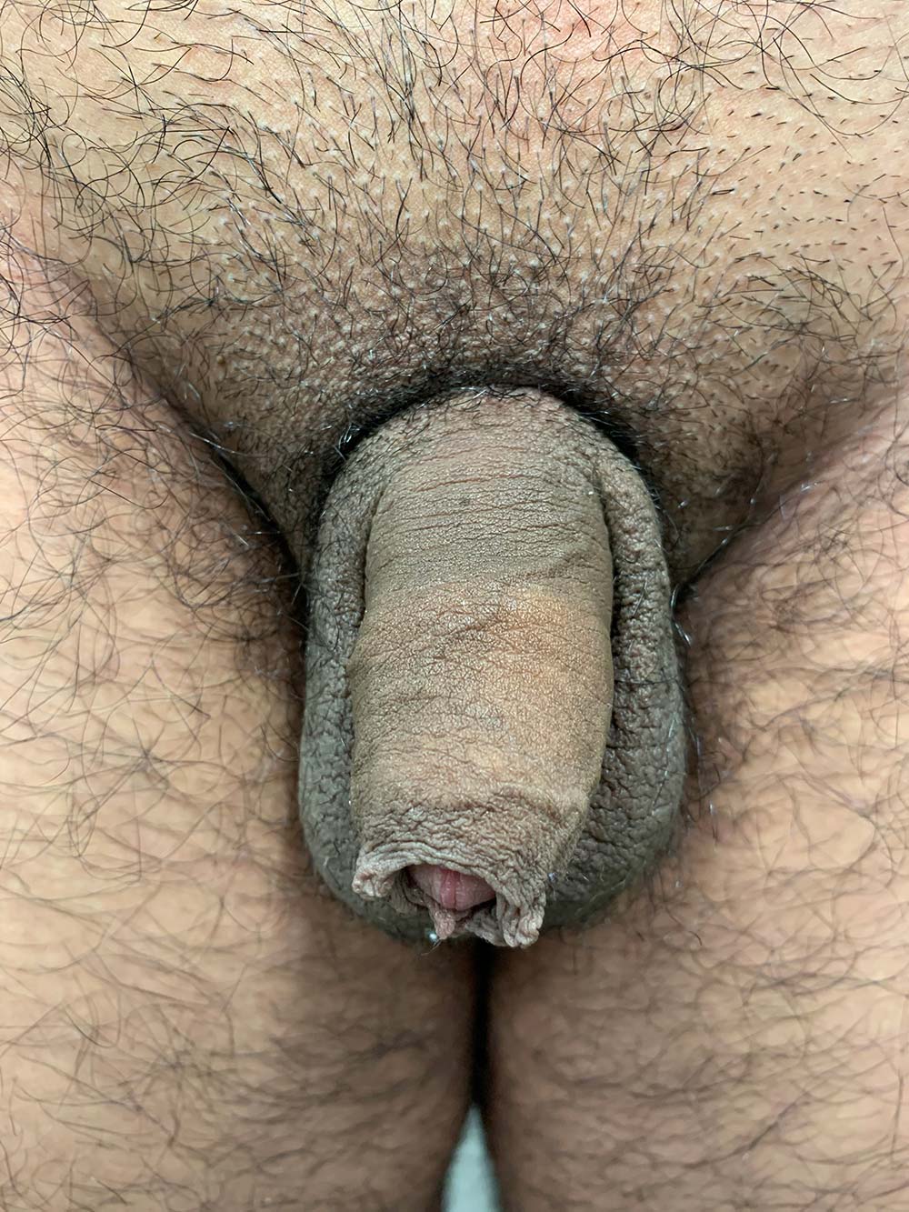 New Circumcisions Before & After Patient #1108