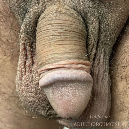 Pearly Penile Papules Before & After Patient #1854