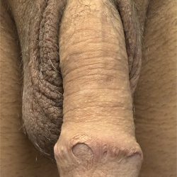 Skin Bridges Before & After Patient #1927