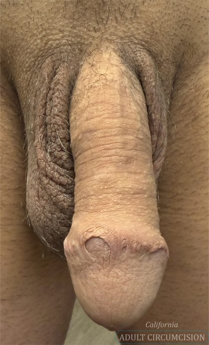 Skin Bridges Before & After Patient #1927