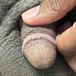 Pearly Penile Papules Before & After Patient #1860
