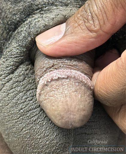 Pearly Penile Papules Before & After Patient #1860