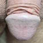 Pearly Penile Papules Before & After Patient #1861