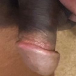 Pearly Penile Papules Before & After Patient #1860