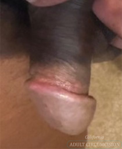 Pearly Penile Papules Before & After Patient #1860