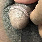 Pearly Penile Papules Before & After Patient #1860
