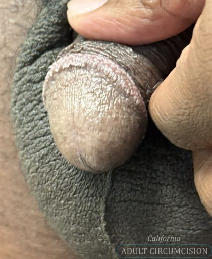 Pearly Penile Papules Before & After Patient #1860