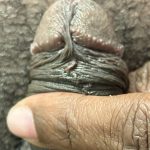 Pearly Penile Papules Before & After Patient #1860