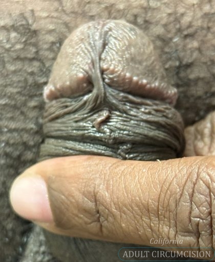 Pearly Penile Papules Before & After Patient #1860