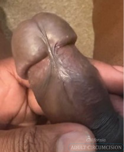 Pearly Penile Papules Before & After Patient #1860